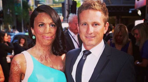 Mulher que teve 65% do corpo queimado vira inspiração por amor verdadeiro