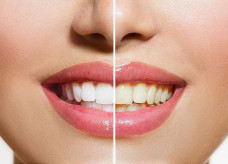 Apesar de ser um problema apenas estético, o escurecimento dos dentes é uma das maiores reclamações nos consultórios odontológicos