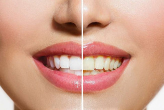 Apesar de ser um problema apenas estético, o escurecimento dos dentes é uma das maiores reclamações nos consultórios odontológicos