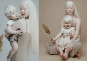 Irmãs albinas com 12 anos de diferença surpreendem por beleza